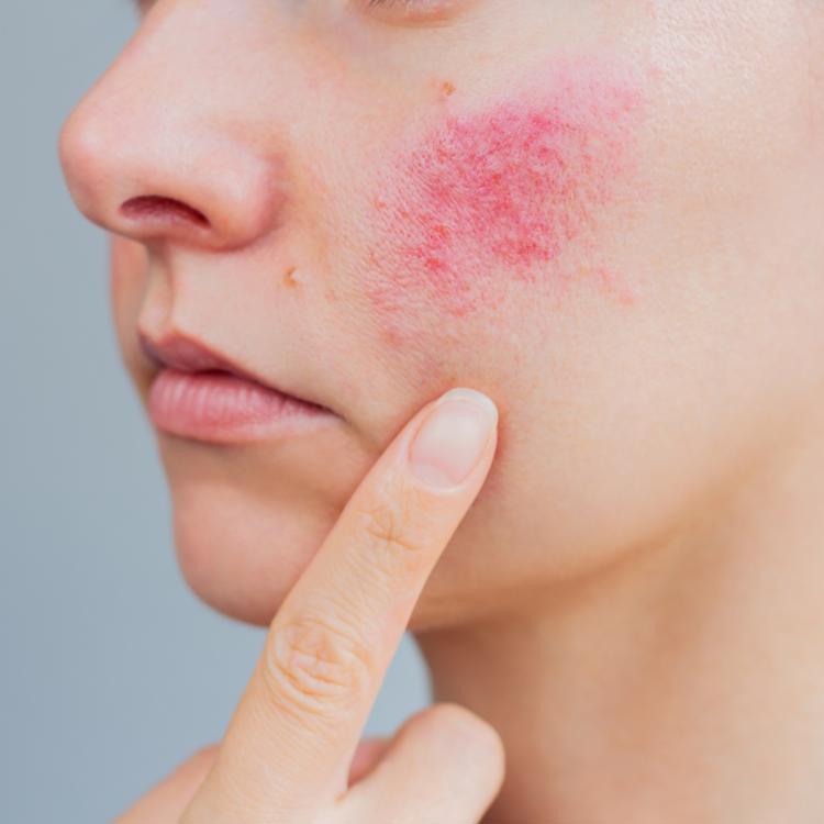 A woman displaying signs of rosacea on her face