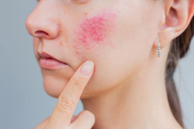 A woman displaying signs of rosacea on her face