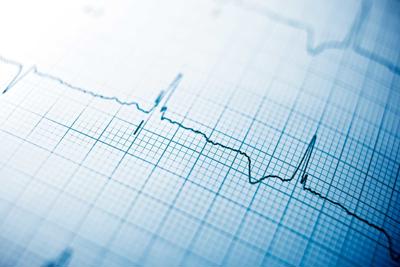Electrocardiogram